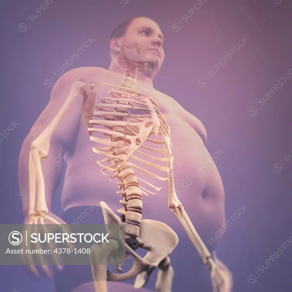 Human skeleton layered over overweight man's back to reveal the impact of his condition.