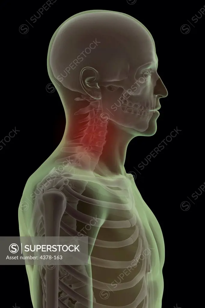 Side view of the bones of the head and neck. The cervical vertebrae are highlighted red to indicate pain or injury.