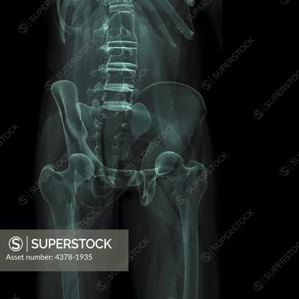 X-Ray image showing the pelvic region.