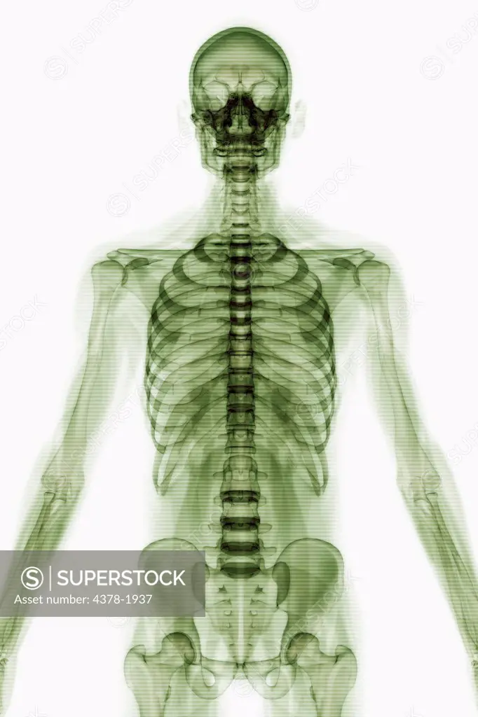 X-Ray image showing the rib cage and pelvis.