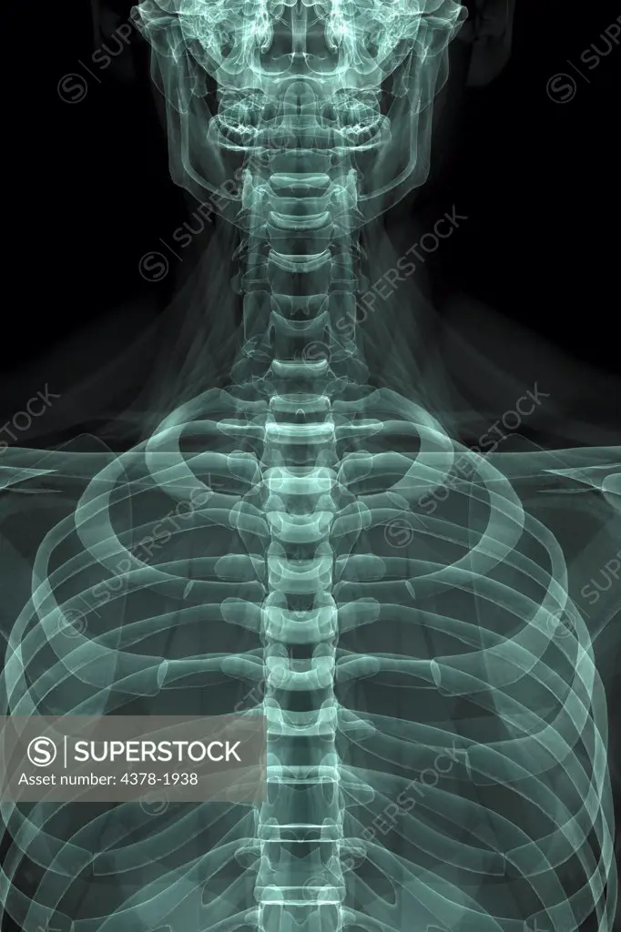 X-Ray image showing the rib cage.