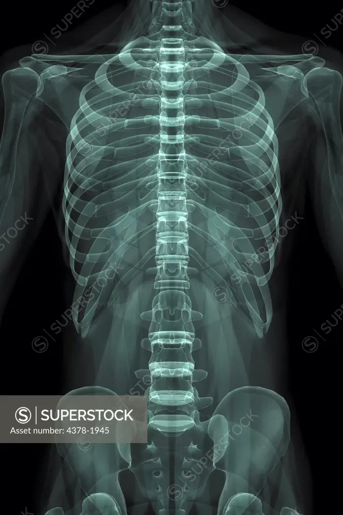 X-Ray image showing the rib cage and pelvis.