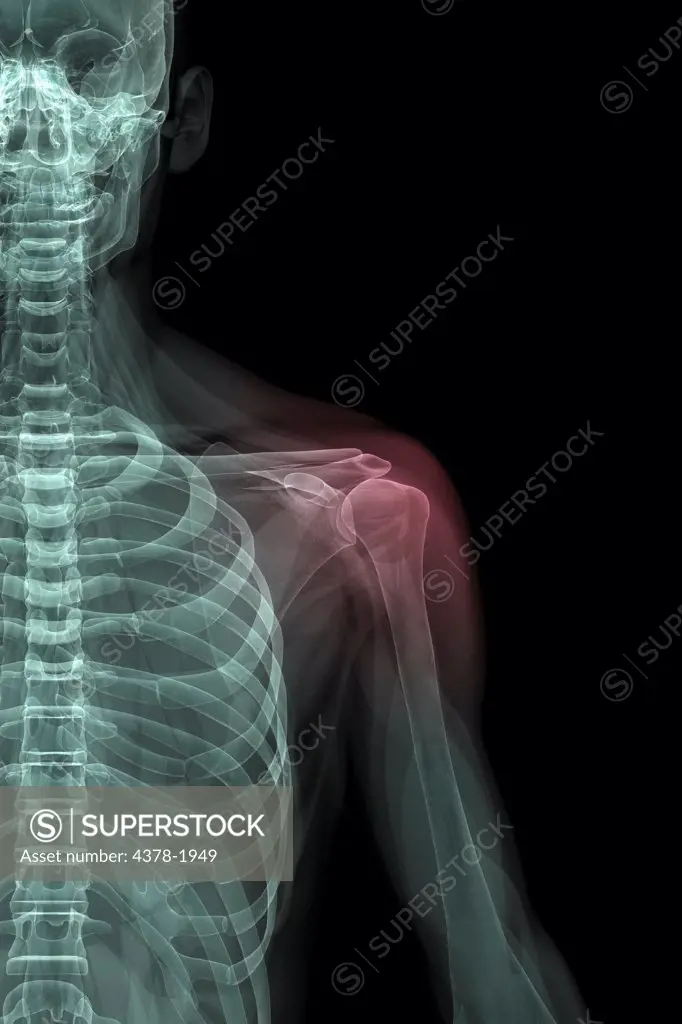 X-ray image showing an inflammation of the shoulder joint.