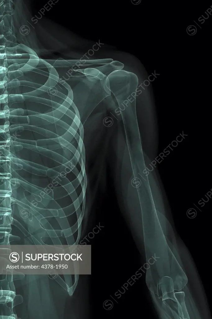 X-ray image showing the shoulder joint.