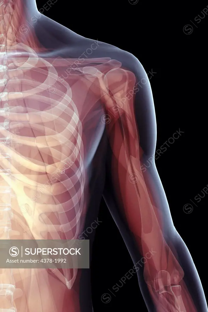 X-ray image showing the skeletal structure of the humerus and rib cage.