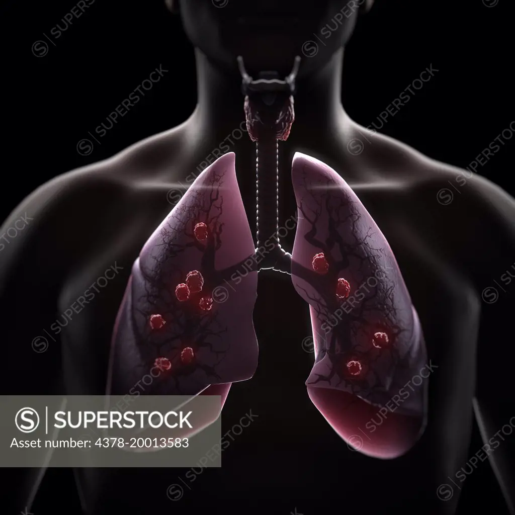 Multiple Lung Tumors