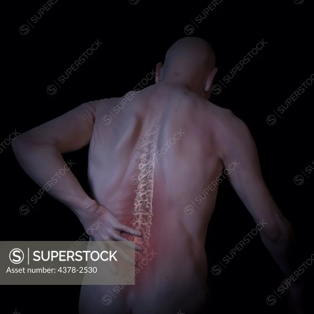 Anatomical model showing an inflamed area affected by back pain.