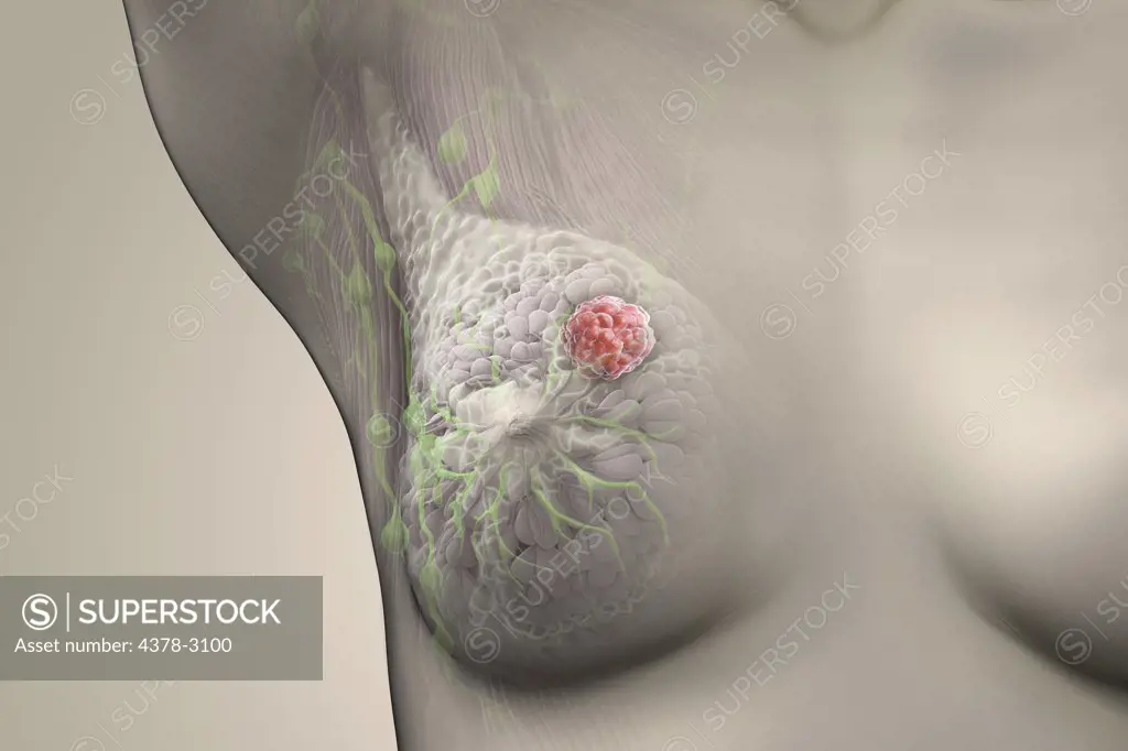 Front view of female breast anatomy with a lump present.