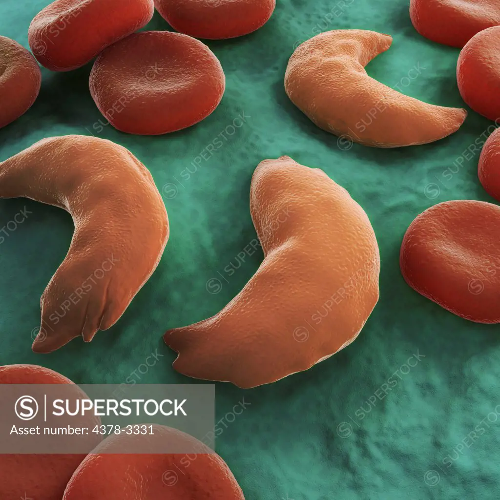 Sickle-cell disease, sickle-cell anaemia or drepanocytosis is a recessive genetic blood disorder characterized by red blood cells that assume an abnormal, rigid, sickle shape. Here healthy blood cells are seen along with diseased cells.