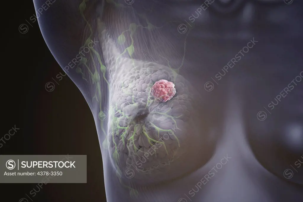 Front view of female breast anatomy with a lump present.
