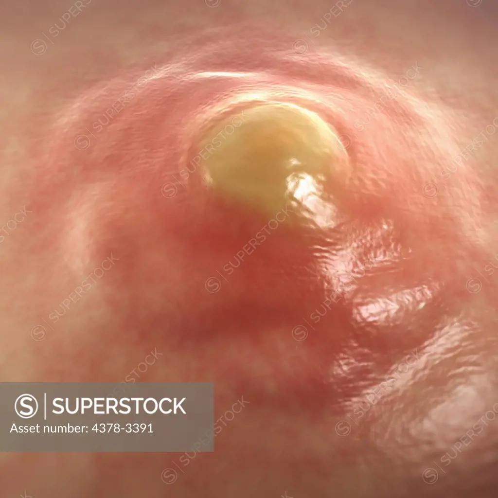 A boil or furuncle is a result of folliculitis which is a deep infection of the hair follicle. Note the pus filled lump and inflamed red skin.