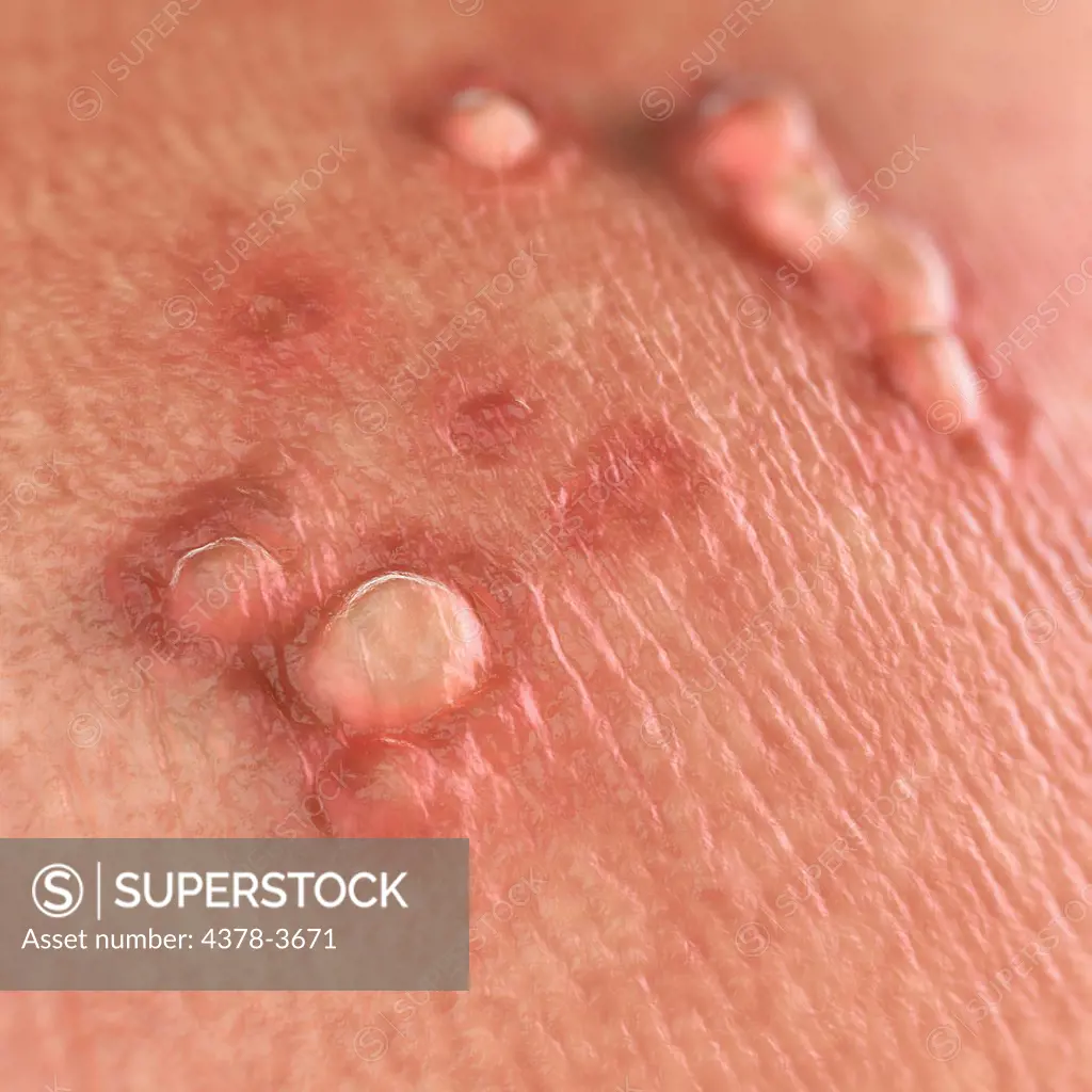 Close up view of warts. Warts are caused by the human papilloma virus or HPV.