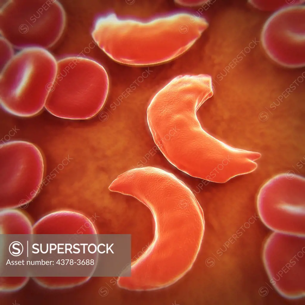 Sickle-cell disease, sickle-cell anaemia or drepanocytosis is a recessive genetic blood disorder characterized by red blood cells that assume an abnormal, rigid, sickle shape. Here healthy blood cells are seen along with diseased cells.