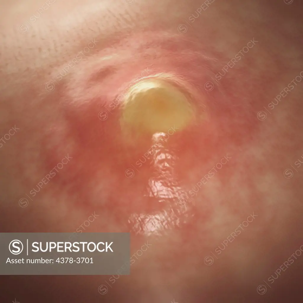 A boil or furuncle is a result of folliculitis which is a deep infection of the hair follicle. Note the pus filled lump and inflamed red skin.