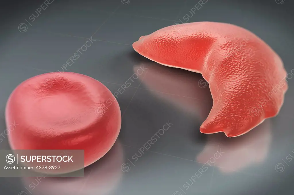 Sickle-cell disease, sickle-cell anaemia or drepanocytosis is a recessive genetic blood disorder characterized by red blood cells that assume an abnormal, rigid, sickle shape. Here a healthy blood cell is seen along with a diseased cell.