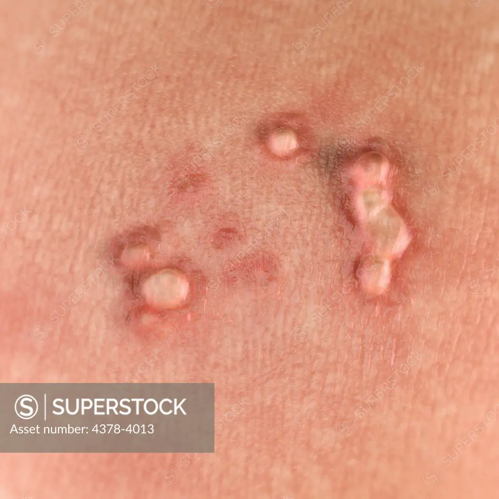 Close up view of warts. Warts are caused by the human papilloma virus or HPV.