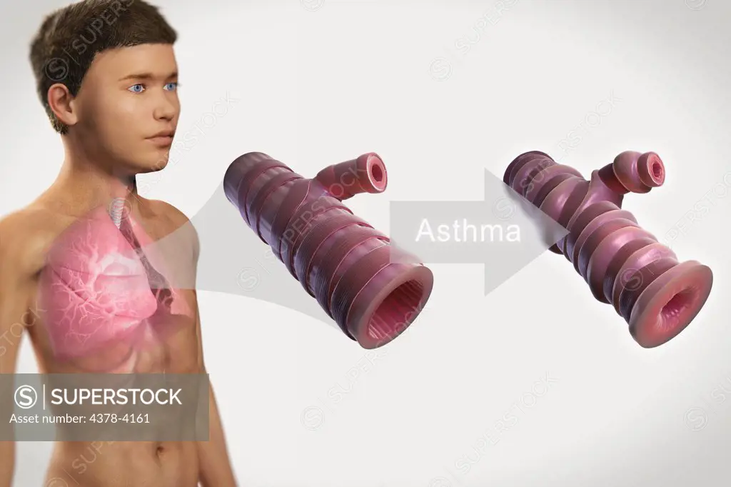 Asthmatic Airway