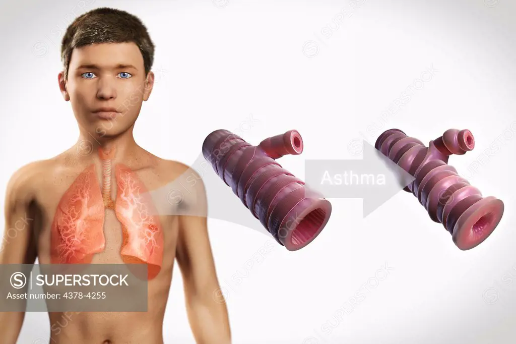 Asthmatic Airway