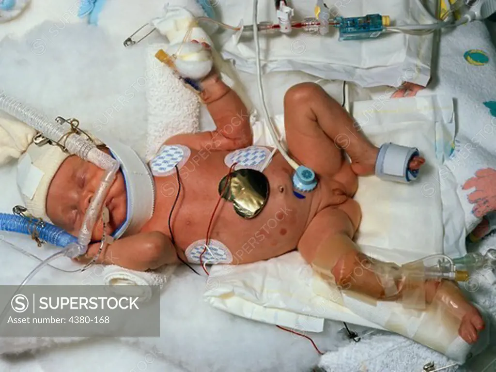 A Premature Infant in Neonatal ICU