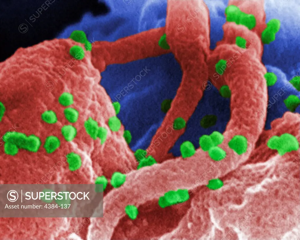 This scanning electron micrograph revealed the presence of the human immunodeficiency virus (HIV-1), (spherical in appearance), which had been co-cultivated with human lymphocytes.