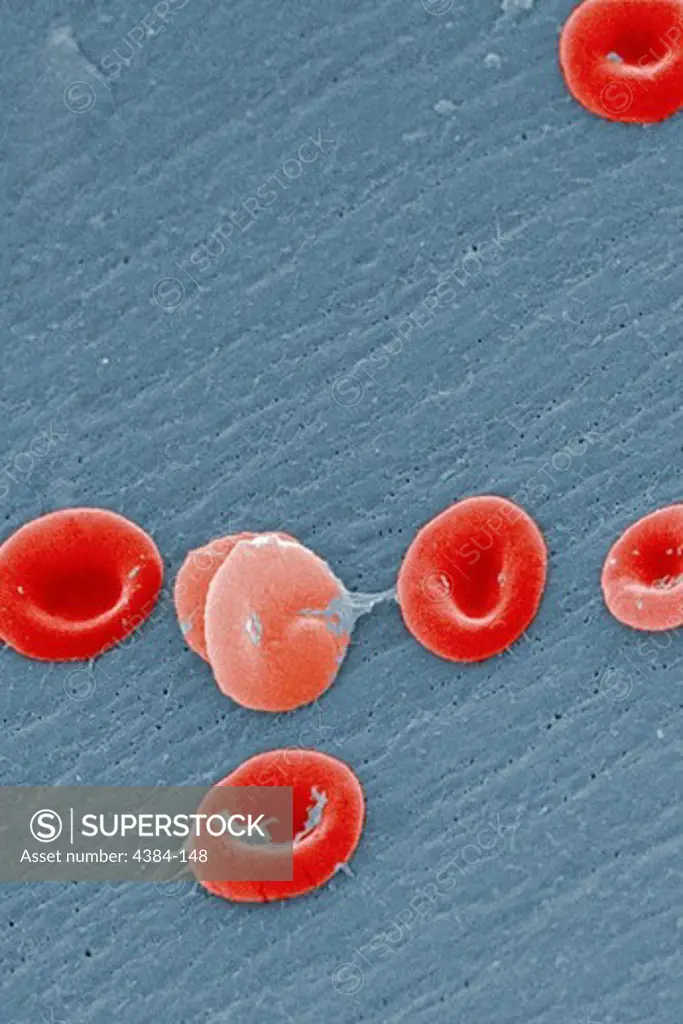 This scanning electron micrograph (SEM) revealed some of the ultrastructural morphology displayed by red blood cells (RBCs) in a blood specimen of a 6 year old male patient with sickle cell anemia, which was accompanied by hereditary persistence of fetal hemoglobin (HPFH). In these individuals, the presence of the persistent fetal hemoglogin reduces the severity of the consequences of the sickle cell disease, thereby, reducing the degree of cellular deformity, i.e., sickling, seen in the sickled