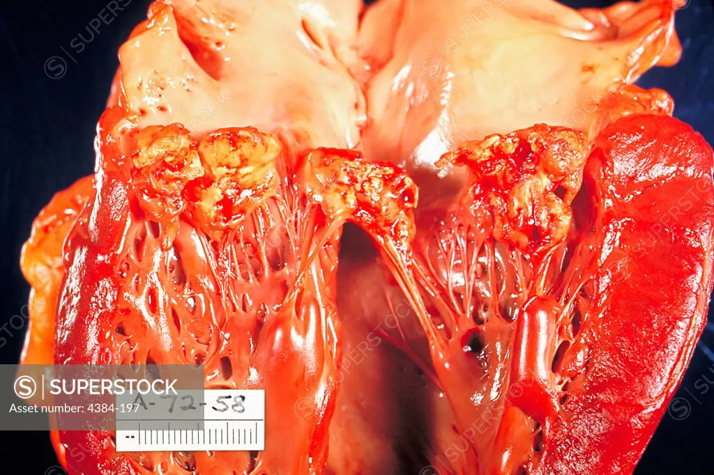 The left ventricle of heart has been opened to show mitral valve fibrin vegetations due to infection with Haemophilus parainfluenzae, which was caused by subacute bacterial endocarditis.