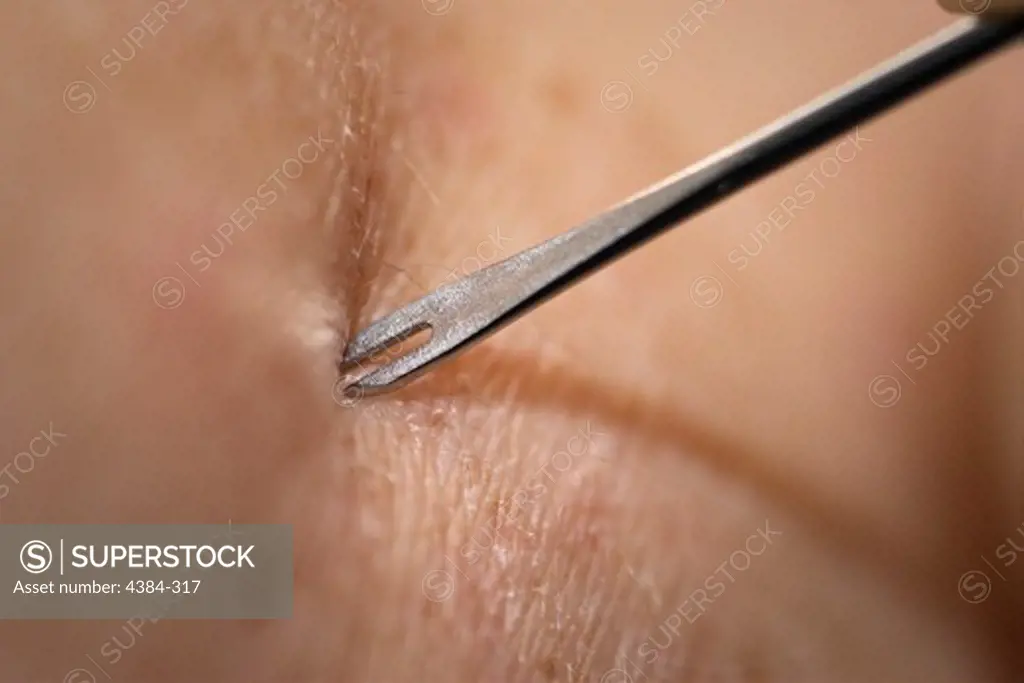 Clinician Demonstrates Use of Bifurcated Needle