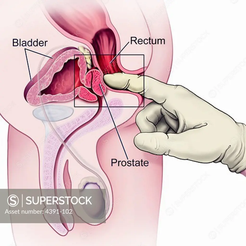 A cutaway view of the male reproductive and urinary systems shows the proper method for examining the prostrate for any abnormalites.
