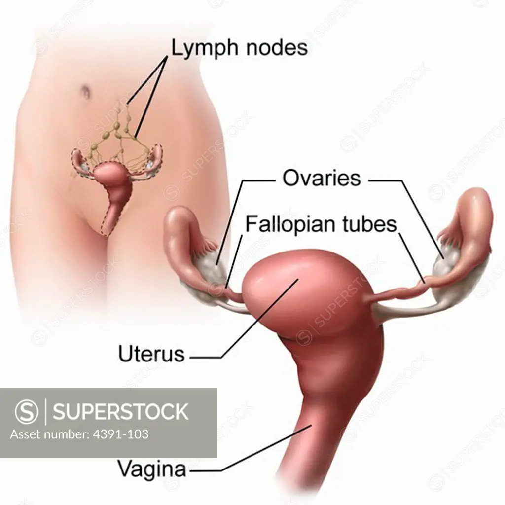 The female reproductive system, centered around the uterus. Two types of uterine cancer are endometrial cancer (cancer that begins in cells lining the uterus) and uterine sarcoma (a rare cancer that begins in muscle or other tissues in the uterus). Drawing by Alan Hoofring and Don Bliss.