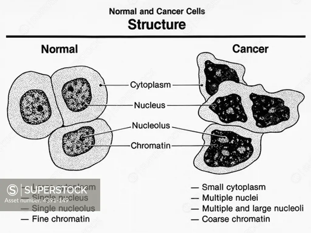An artist's rendition of the structure of normal cells and cancer cells, showing the characteristics of both. Cancer cells exhibt increased but unstructured growth.  Illustration by Pat Kenny.