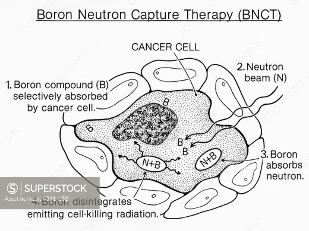 An illustration of Boron Neutron Capture Therapy (BNCT) a type of treatment for cancer. 1) Boron compound (b) is selectively absorbed by cancer cell(s). 2) Boron beam (n) is aimed at cancer site. 3) Boron absorbs neutron. 4) Boron disintegrates emitting cancer-killing radiation. Illustration by Pat Kenny.