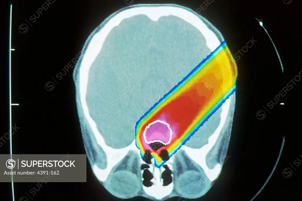 A composite of several CT (computed tomography) scans shows the yellow line of a proton beam field-shaping aperture, firing at a tumor in the brain (red).