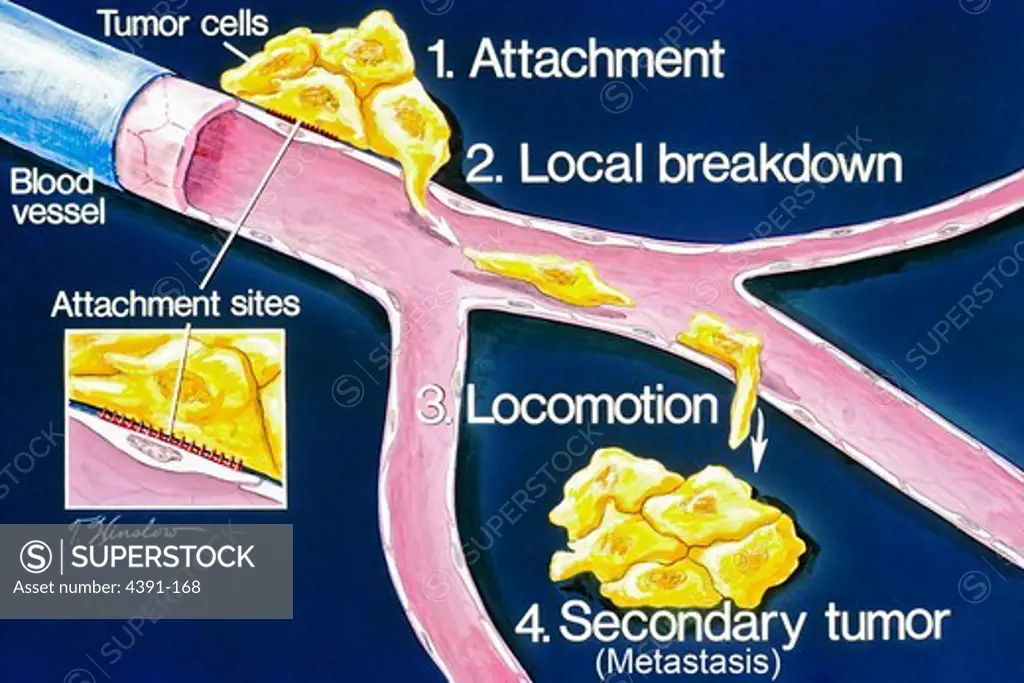 This is a schematic drawing of the stages of metastasis 1) attachment 2) local breakdown 3) locomotion 4) secondary tumor. This illustration explains the process of metastasis. Once metastatic cells are attached to the basement membrane (a physical barrier that seperates tissue components), they break through with the help of an enzyme called type IV collagenase. Cancer cells then move through the blood stream enabling them to spread to other parts of the body. A secondary tumor may form at anot