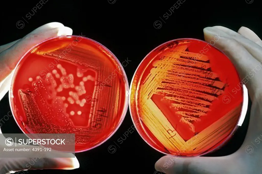 Red blood cells on an agar plate are used to diagnose infection. The plate on the left shows a positive staphyloccus infection. The plate on the right shows a positive streptococcus infection and with the halo effect shows specifically a beta-hemolytic group A. These infections can occur in patients on chemotherapy. Photo by Bill Branson.