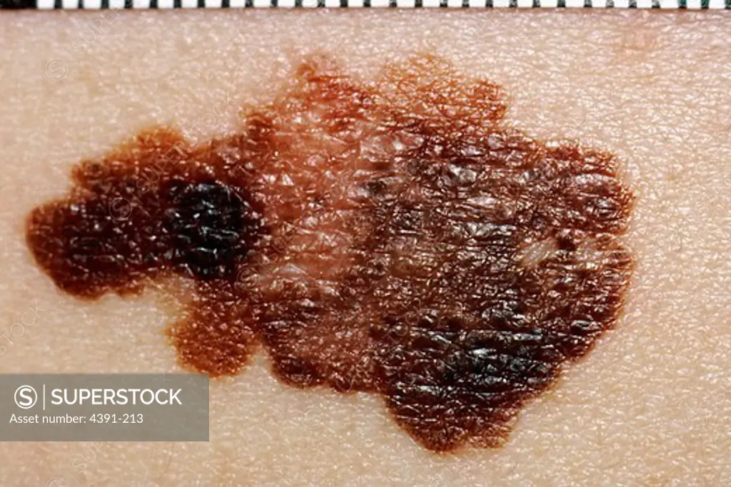 A melanoma - a skin cancer - on a patient's skin.