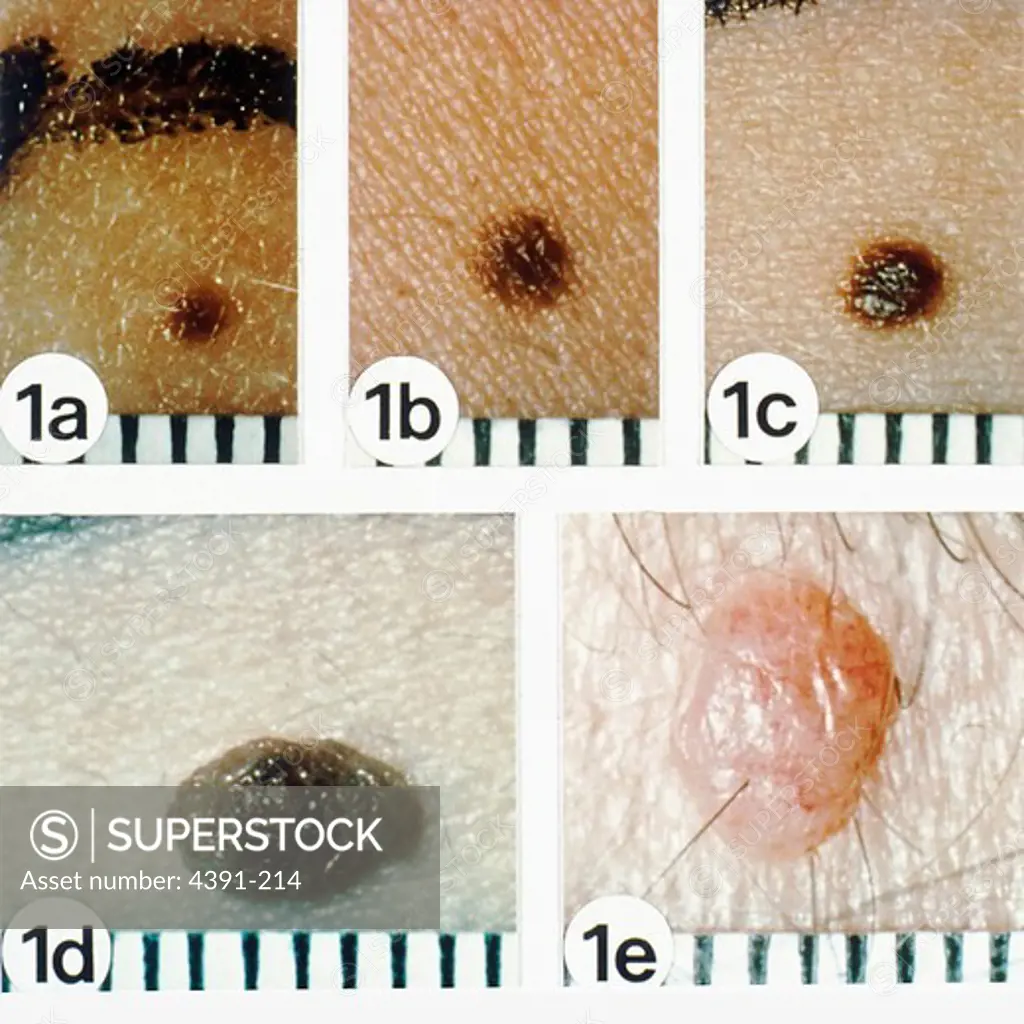 Natural history of common acquired nevi. Ordinary moles begin as uniformly tan or brown macules, 1 to 2 mm in diameter (a), expand to a larger macule (b), progress to a pigmented papule that may be minimally (c) or obviously (d) elevated above the surface of the skin, and terminate as a pink or flesh-colored papule (e). These lesions are junctional (a,b), compound (c,d), and dermal (e) nevi, respectively. Note their smooth borders and clear demarcation from the surrounding skin.