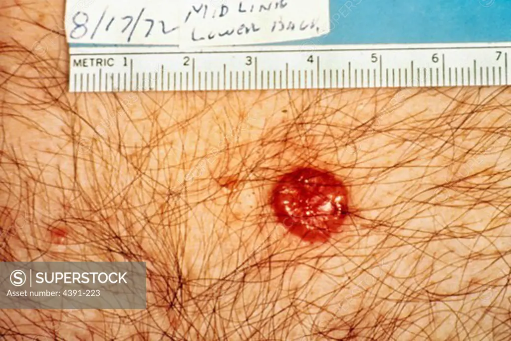 A basal cell carcinoma presents as a small, reddish/brownish papule, often with telangiectatic blood vessels. It may appear transluscent, and when it is, described as 'pearly' in color. It may have a central depression with rolled borders.