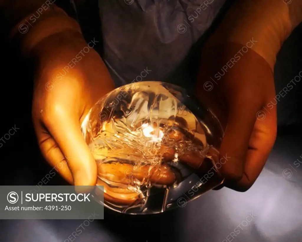 A surgeon holds a breast implant which is a flexible sac filled with silicone gel. A surgeon inserts the sac into the chest just under the skin. This implant can be inflated with air or injected with a saline solution to adjust the size. It is used in reconstructive surgery, sometimes invovling the effects of breast cancer.  Photo by Linda Bartlett.