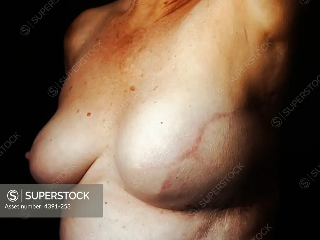 A woman who has had surgical treatment for breast cancer and later breast reconstruction shows her reconstructed breast post mastectomy. Cicatrix is prominent and extends from nipple area to under arm. There is an unobstructed view of scar. Nipple is missing. Photo by Linda Bartlett.