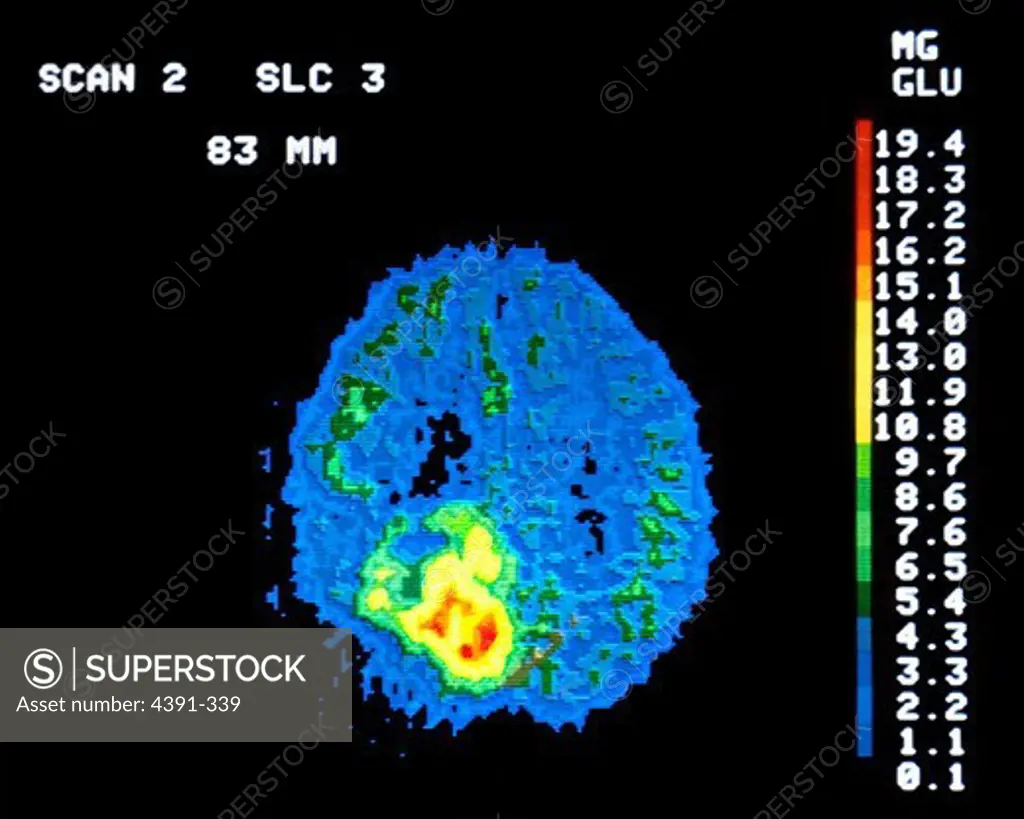 A PET scan (positron emission tomography) of a 62 year old man with a brain tumor classified as a grade III astrocytoma. The PET scan displays an increased glucose metabolic rate shown by the irregular bright white area in the center of the scan.
