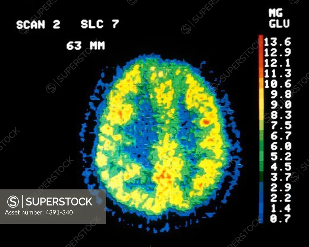 Position emission tomography (PET) of cerebral glucose utilization in a normal individual. This tomogram is through the upper part of the cerebral hemisphere. Note discrimination between gray matter (yellow-red color) and white matter (green-blue color) which uses less glucose.
