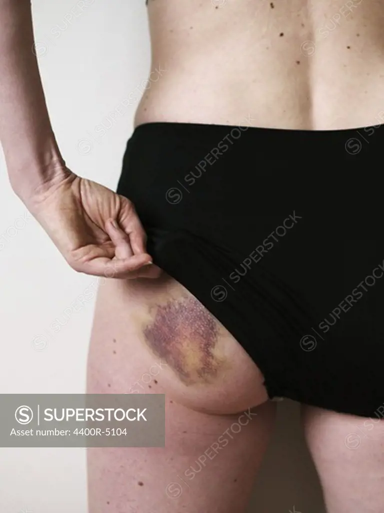 Woman showing bruise on buttock