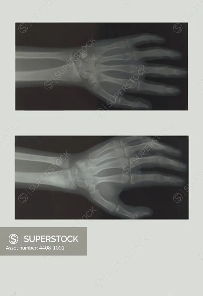Left Hand, Medical - Xray / Radiology