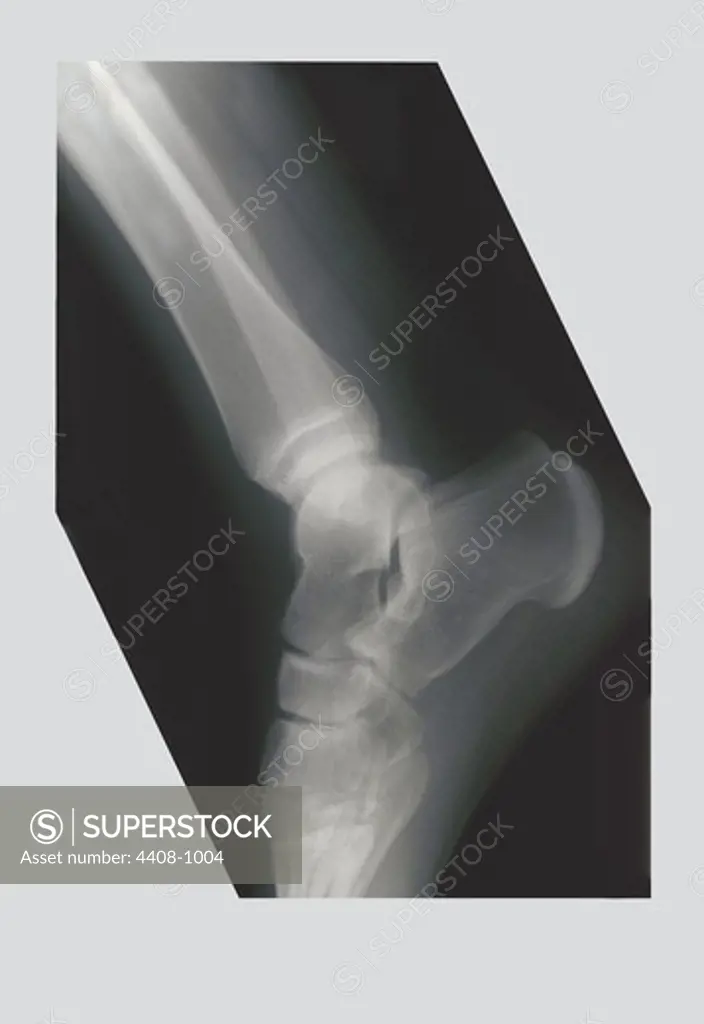 Ankle, Medical - Xray / Radiology