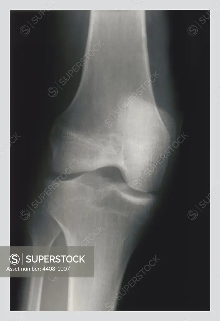 Knee, Medical - Xray / Radiology
