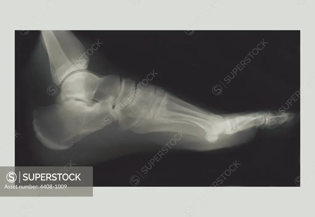 Foot, Medical - Xray / Radiology