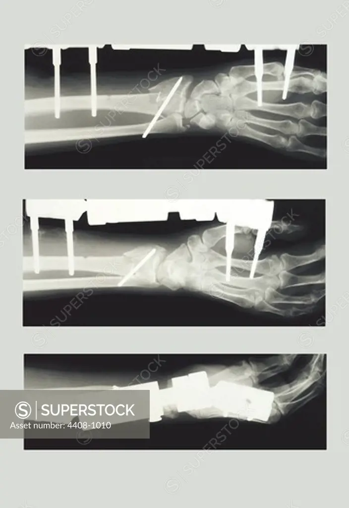 Arm with External Fixation, Medical - Xray / Radiology