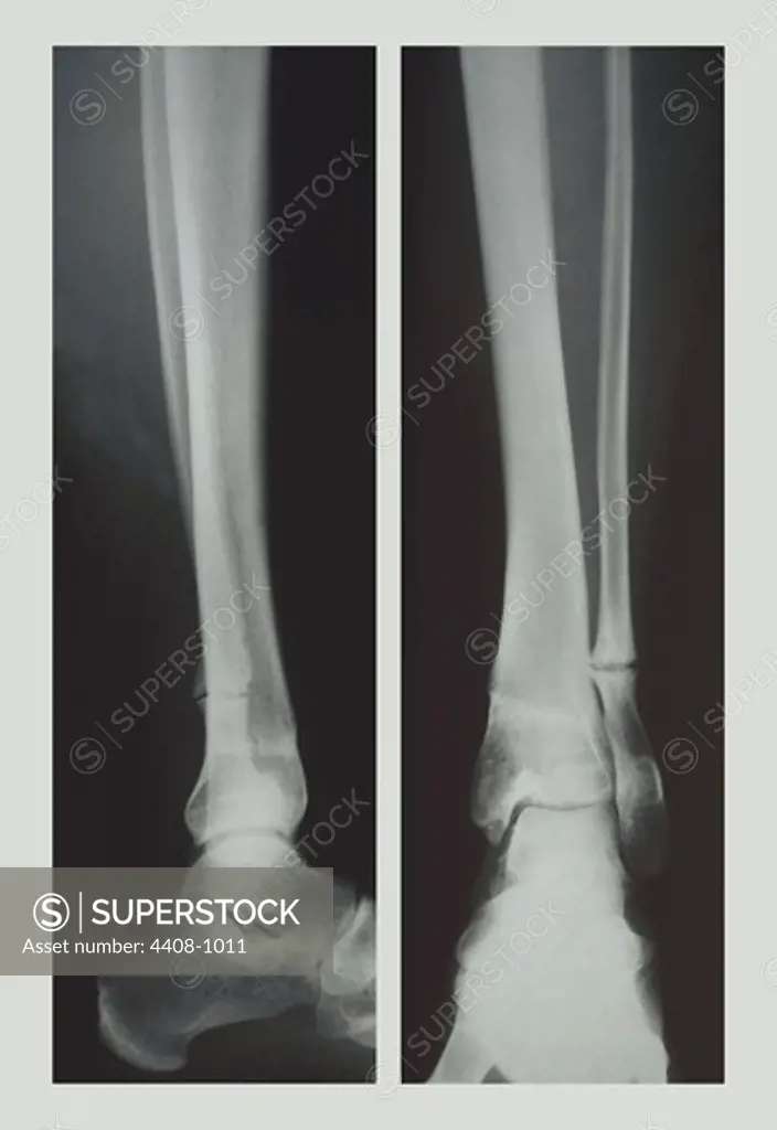 Two Ankles, Medical - Xray / Radiology