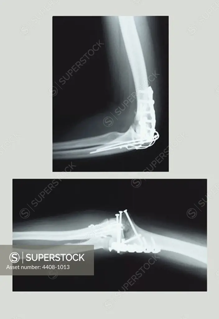 Repaired Elbow, Medical - Xray / Radiology