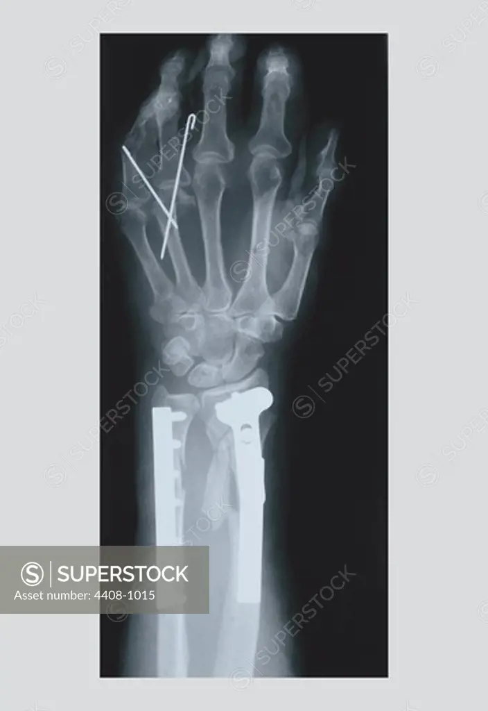 Arm and Finger Repair, Medical - Xray / Radiology